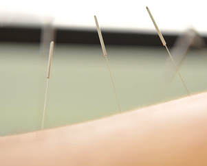 Acupuncture Treatment