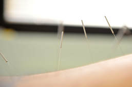 Calgary Acupuncture 